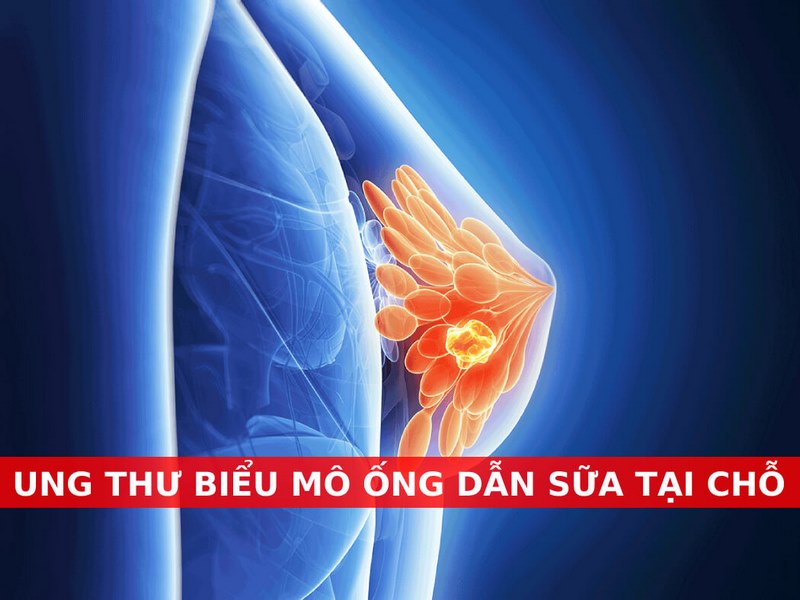 Có thể sờ thấy khối u ở ngực trong Ung thư biểu mô ống dẫn sữa tại chỗ