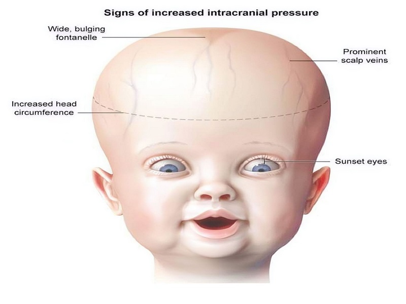 Hội chứng tăng áp lực nội sọ là gì?