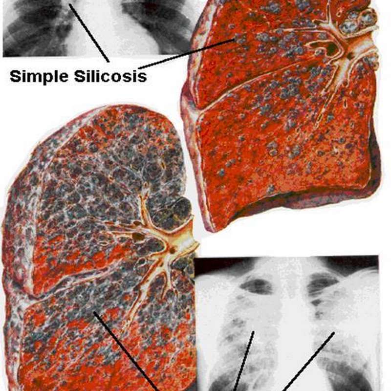 Các triệu chứng của bụi phổi silic