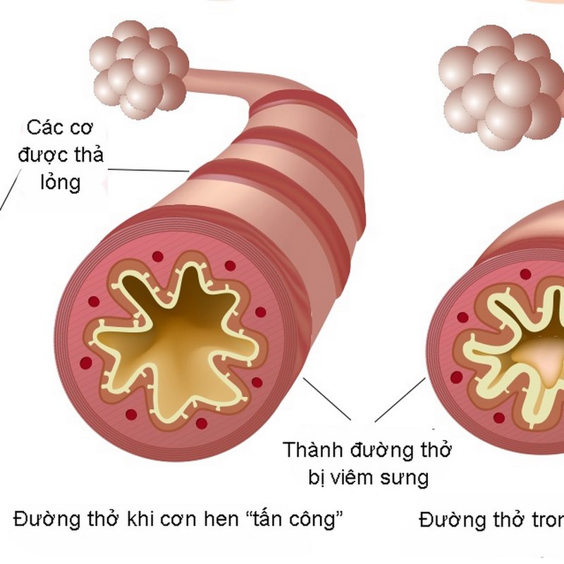 Cơn hen sẽ có biểu hiện khó thở, ho khan và cơ thể căng cơ