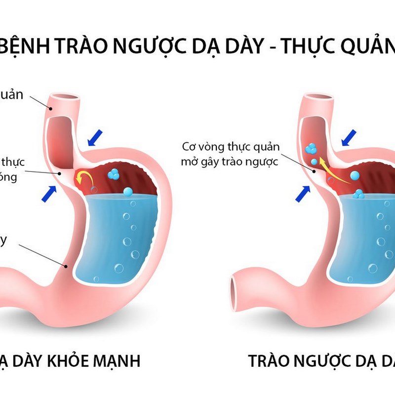 Trào ngược dạ dày là tình trạng khi axit dạ dày trào ngược lên thực quản