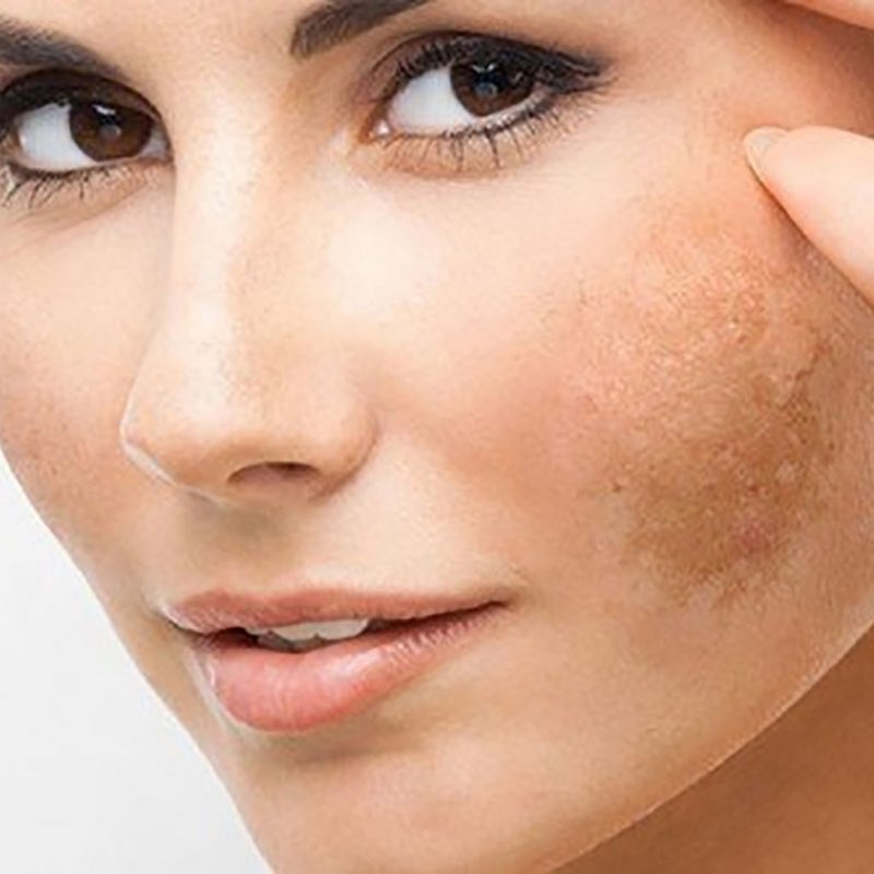 Tác động từ tia UV có thể kích thích sự sản xuất melanin