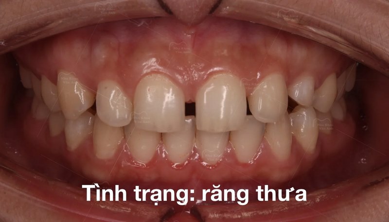 Răng thừa có thể tạo ra sự bất tiện khi nhai hoặc nói chuyện