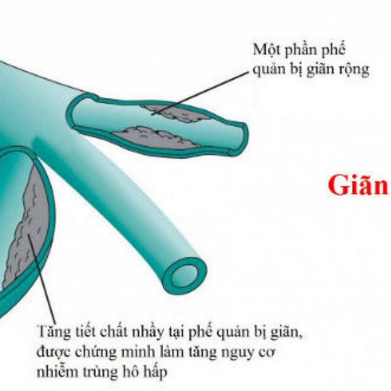 Một số dấu hiệu và triệu chứng của giãn phế quản