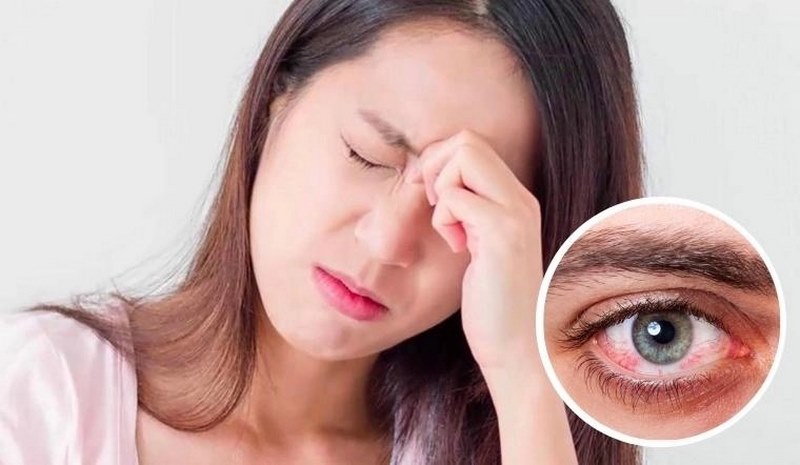 Viêm kết mạc dị ứng là một bệnh lý phổ biến gặp ở mắt