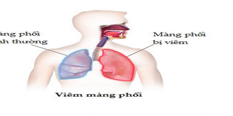 Viêm màng phổi là một bệnh nặng và cần được chăm sóc đúng cách