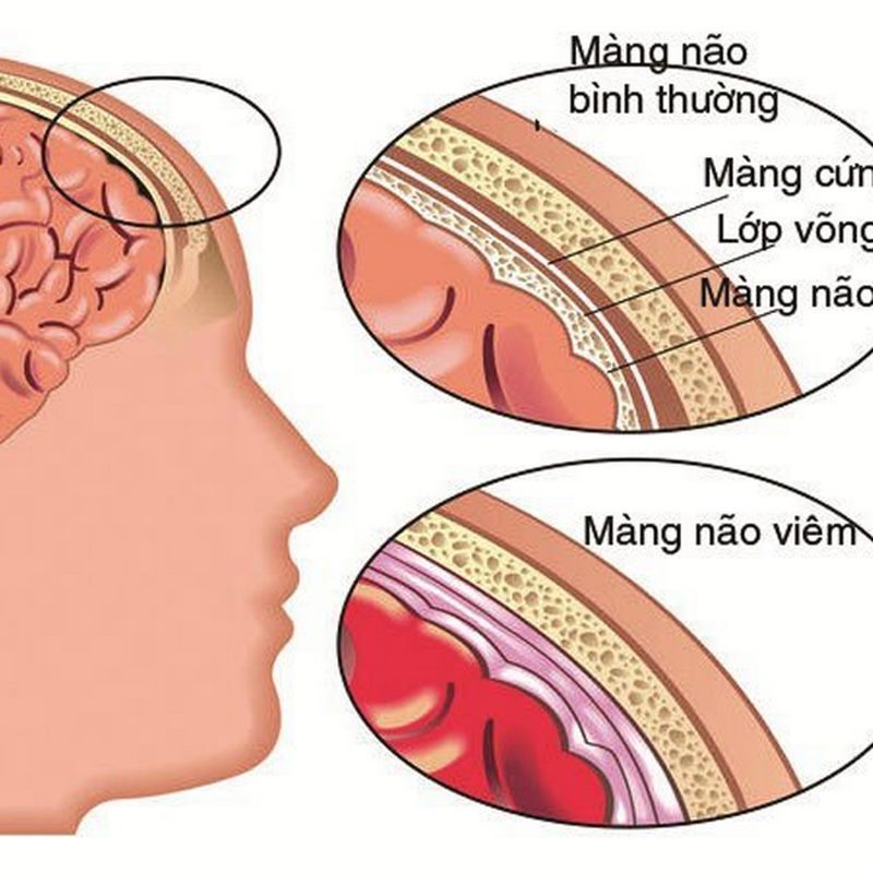 Những dấu hiệu và triệu chứng của Viêm màng não mô cầu