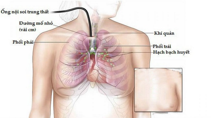 U trung thất là khối u nằm ở trong lồng ngực