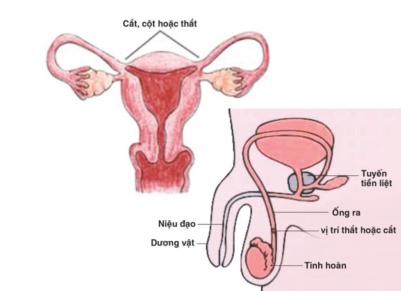 Người muốn thắt ống dẫn tinh bao gồm những người trẻ tuổi