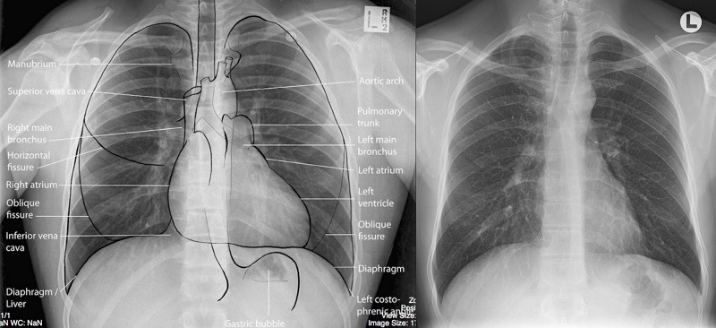 Hầu hết các trường hợp u trung biểu mô do tiếp xúc với sợi amiăng