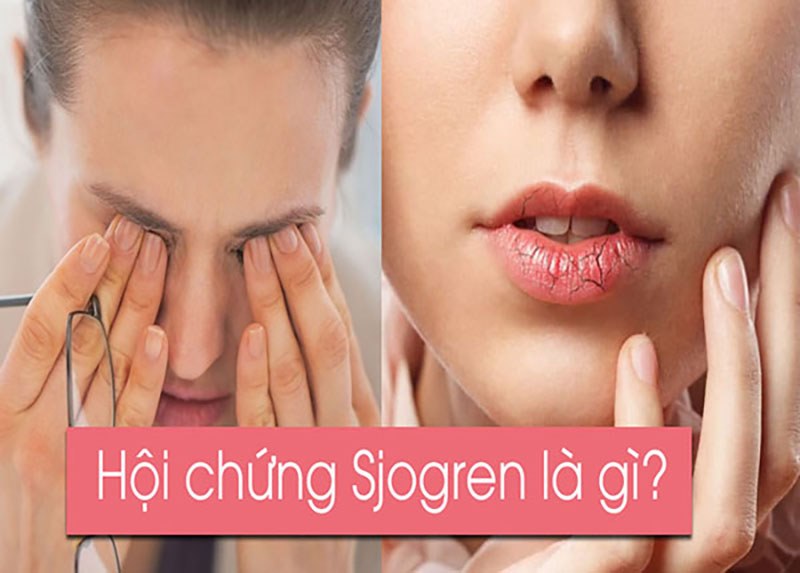 Yếu tố làm tăng nguy cơ mắc phải Hội chứng Sjogren