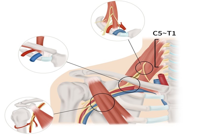 Trong một số trường hợp cần phẫu thuật điều trị hội chứng lối thoát ngực