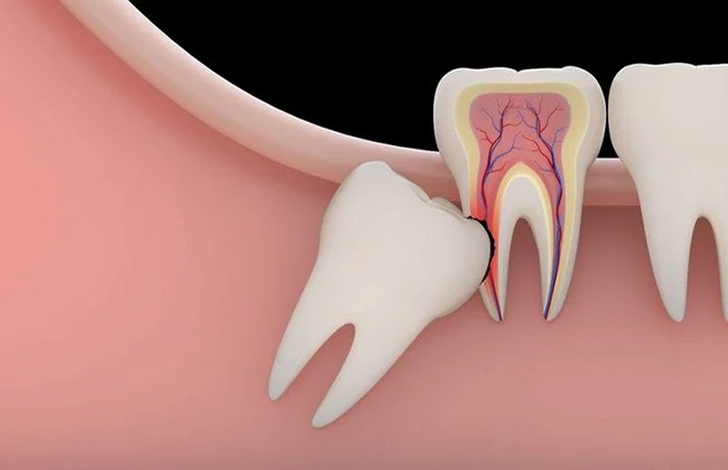 Răng chuyển dịch hoặc đau do áp lực từ răng kẹt