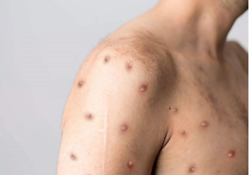 Thủy đậu là tình trạng do virus herpes simplex gây ra