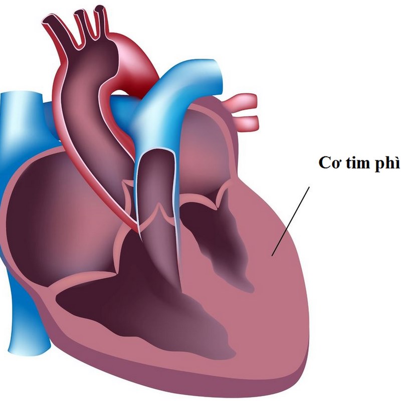 Có một số dấu hiệu và triệu chứng của cơ tim phì đại