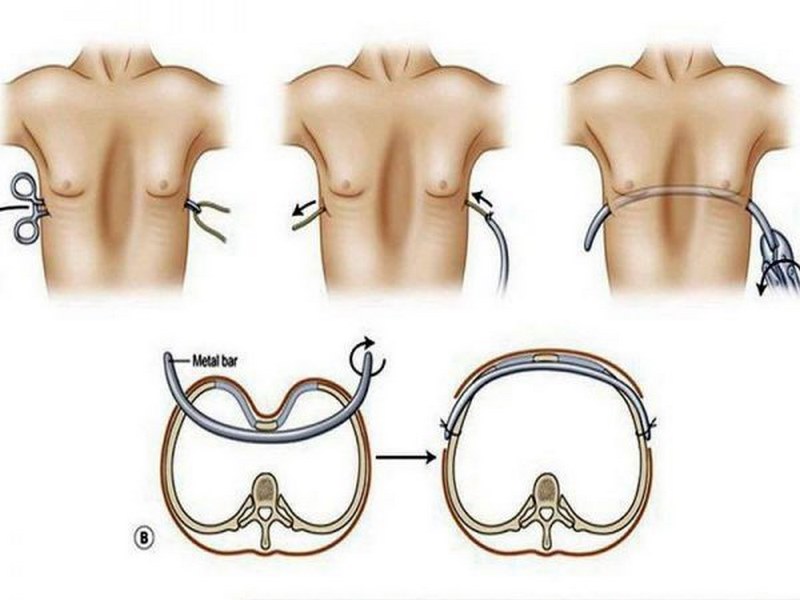 Trẻ mắc lõm ngực bẩm sinh có thể đi kèm với vẹo cột sống