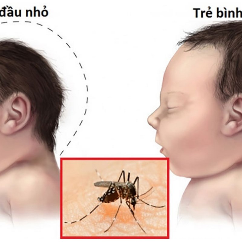 Người đi du lịch đến các khu vực có dịch vi-rút Zika dễ mắc bệnh