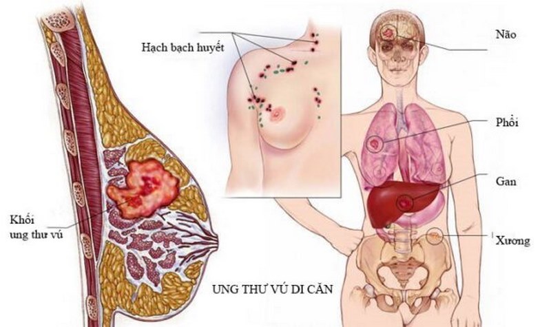 Phụ nữ có kinh nguyệt đều có thể mắc bướu sợi tuyến