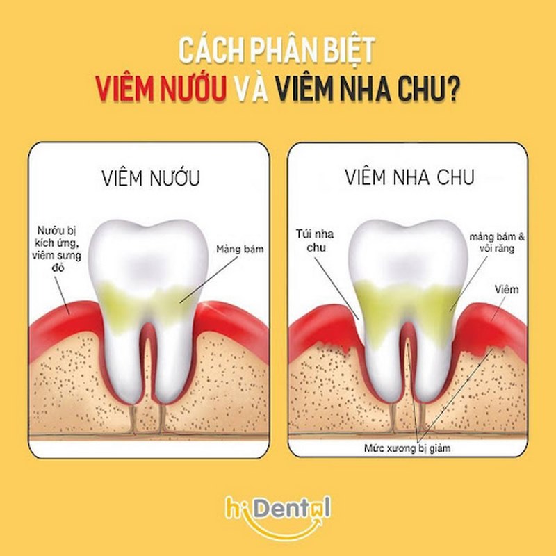 Người có thói quen chăm sóc răng miệng kém dễ mắc bệnh răng miệng