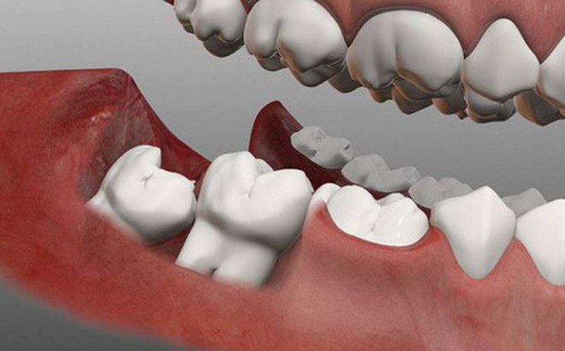 Những người có răng mọc không đúng hướng