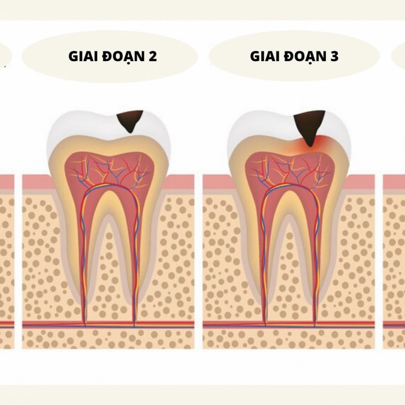 Nếu viêm tủy răng không nghiêm trọng, bạn có thể chỉ cần tẩy trắng răng