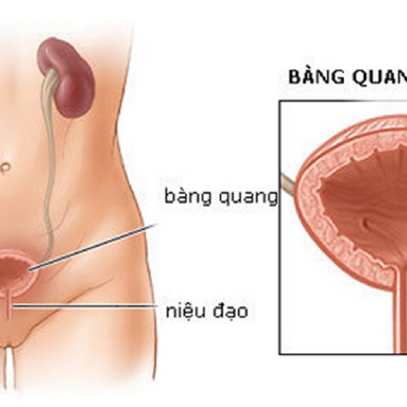 Đau và rát khi đi tiểu là một trong những triệu chứng phổ biến của sỏi bàng quang