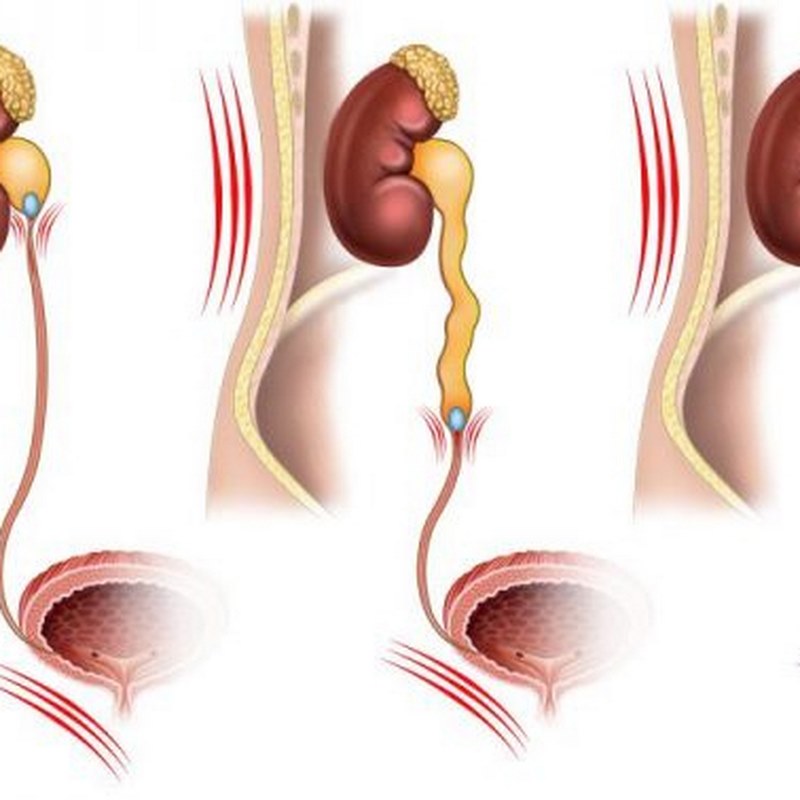 Đau vùng thận hoặc cảm giác đau lưng