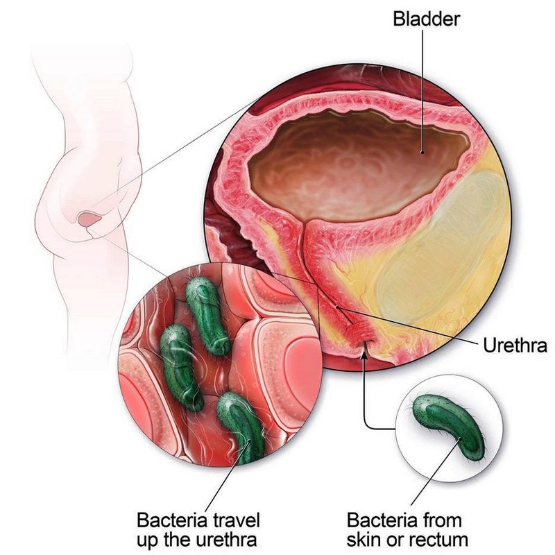 Viêm bàng quang có thể do nhiều nguyên nhân khác nhau
