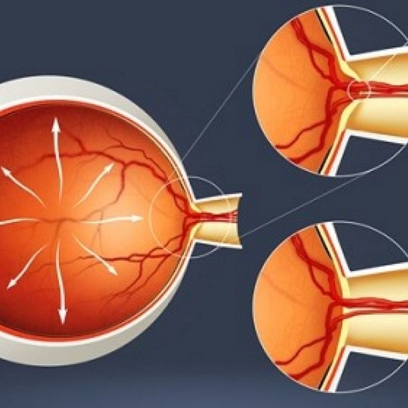 Bệnh nhân có thể cảm thấy đau mắt một cách đột ngột và nhanh chóng