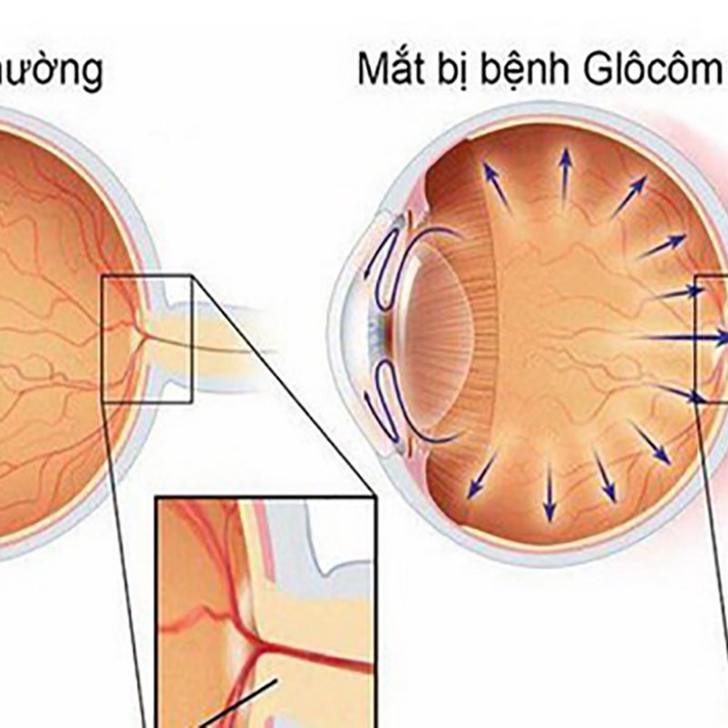 Glaucoma góc mở nguyên phát là một loại bệnh mắt do áp lực trong mắt tăng cao