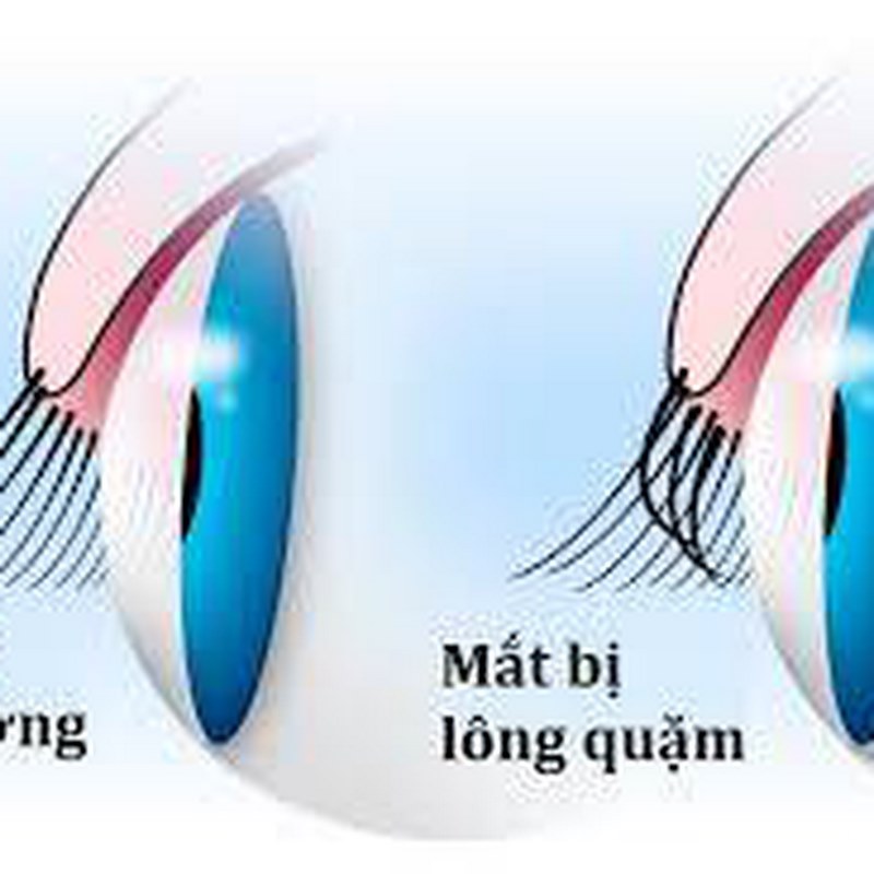 Dấu hiệu và triệu chứng của Lông quặm