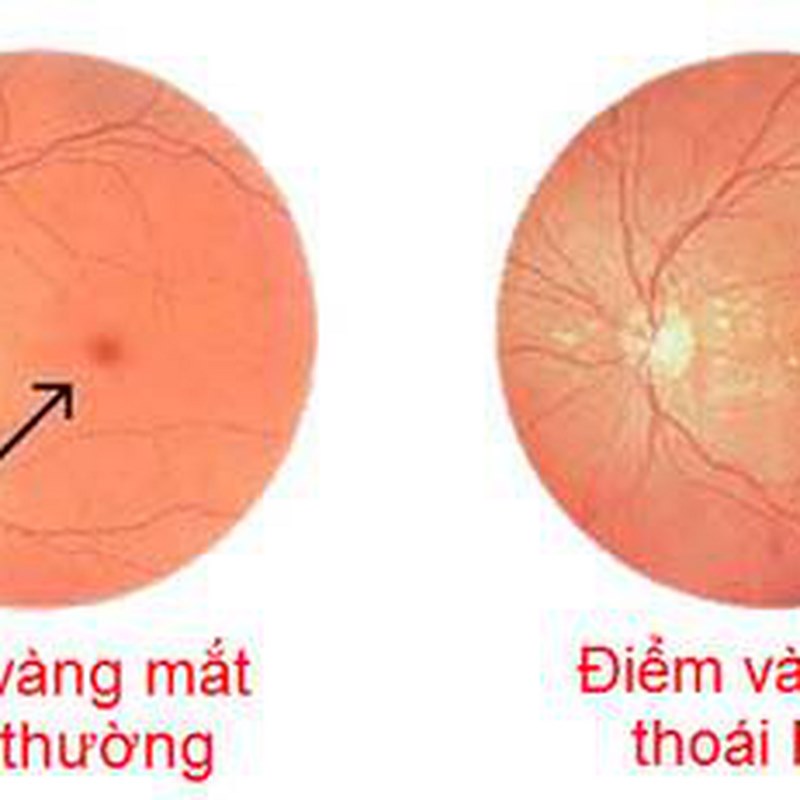 Dấu hiệu và triệu chứng của Thoái hóa điểm vàng