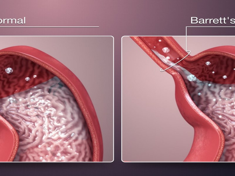 Người bệnh thường có các triệu chứng như đau âm ỉ