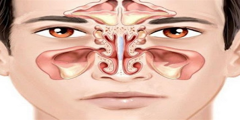 Polyp mũi là một tình trạng phổ biến chưa rõ nguyên nhân