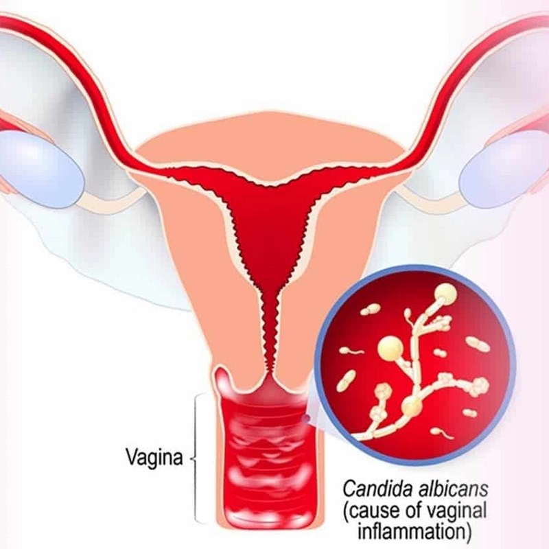 Các vết thương do mổ cạo hoặc gây mổ sau sinh dễ nhiễm khuẩn