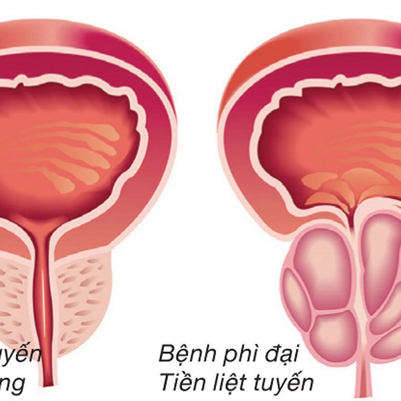 Những người có di truyền gia đình dễ mắc bệnh