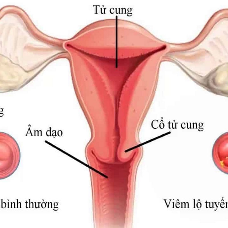 Phụ nữ có hành vi cố ý tiếp xúc với người mắc bệnh lây nhiễm viêm cổ tử cung