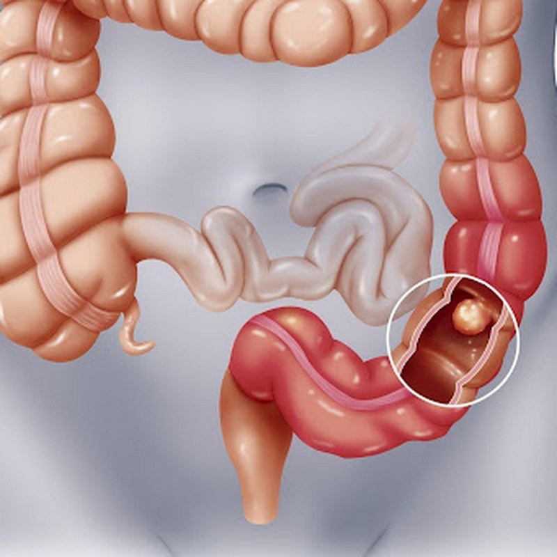 Nhiễm giun đũa là một vấn đề phổ biến, nhất là ở trẻ em