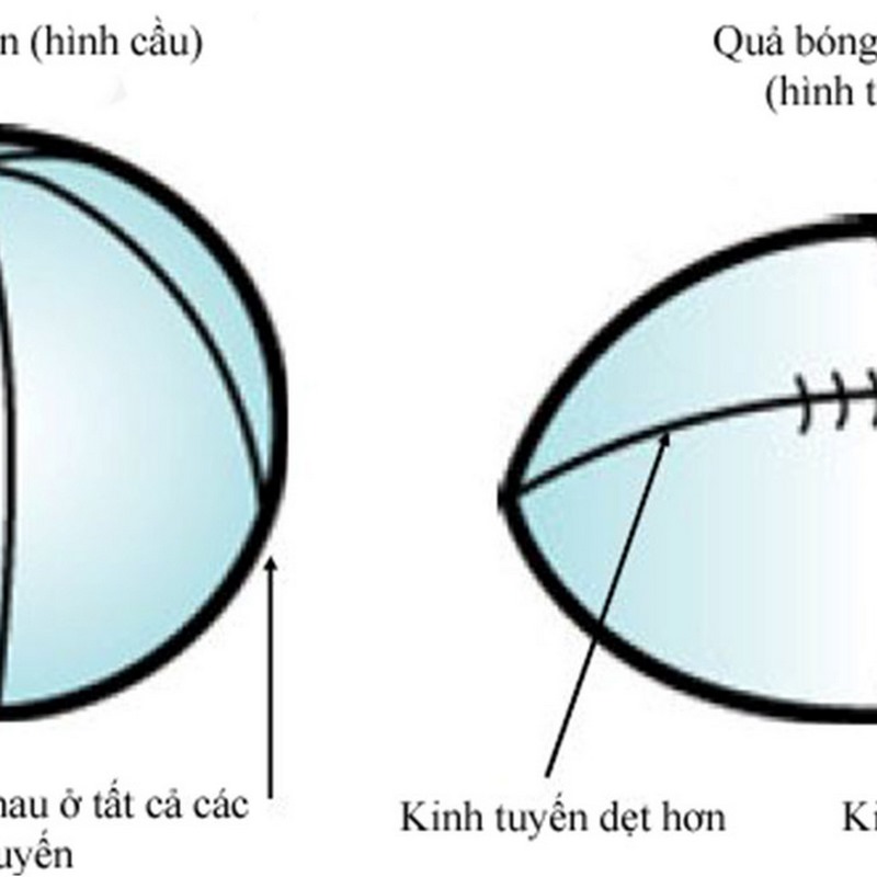 Yếu tố làm tăng nguy cơ mắc phải Loạn thị