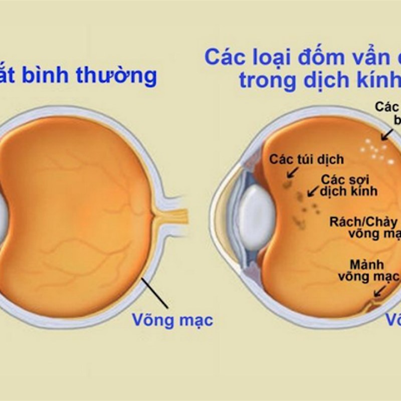 Dấu hiệu và triệu chứng của Vẩn đục dịch kính