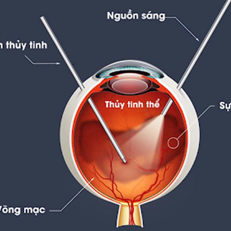 Người cao tuổi có nguy cơ cao hơn mắc phải vẩn đục dịch