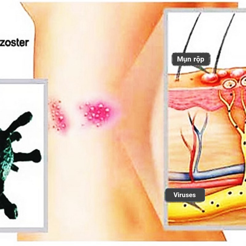 Bác sĩ sẽ kiểm tra vùng da bị tổn thương và xem xét các triệu chứng