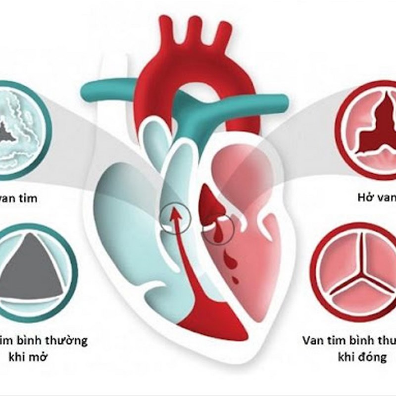 Triệu chứng của bệnh van tim thường phụ thuộc vào mức độ nghiêm trọng của bệnh