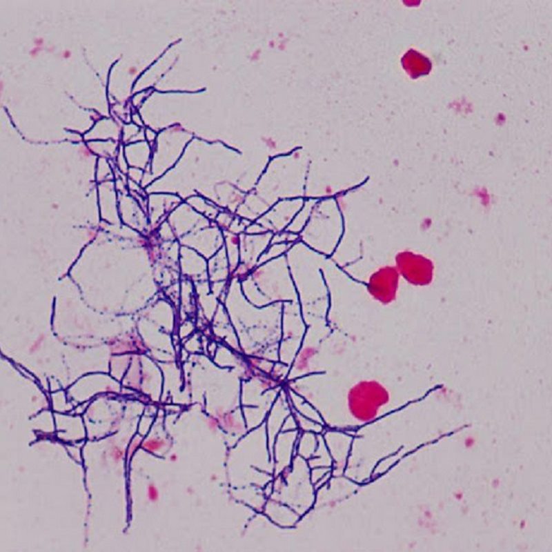 nhóm người có nguy cơ mắc phải Nhiễm Nocardia