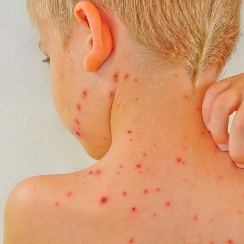 Rubella là một bệnh truyền nhiễm gây ra bởi virus rubella