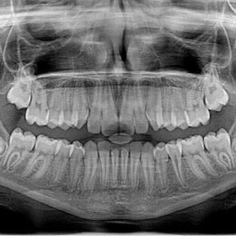 Hạn chế các loại thức ăn chua, cay, cứng để phòng đau răng