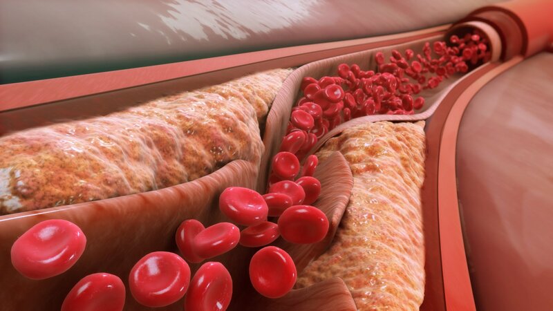 Cholesterol máu cao dễ dẫn đến xơ vữa động mạch