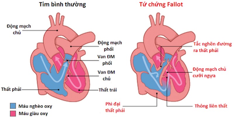 Trẻ mắc tứ chứng Fallot có thể gặp tình trạng chậm tăng trưởng và phát triển