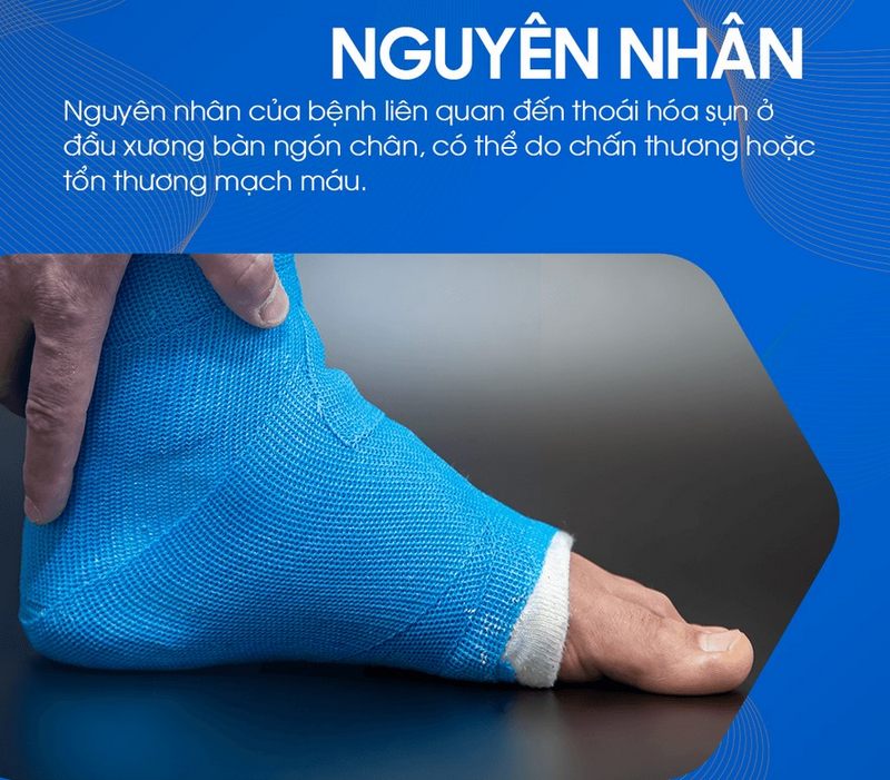 Nguyên nhân dẫn đến bệnh Freiberg