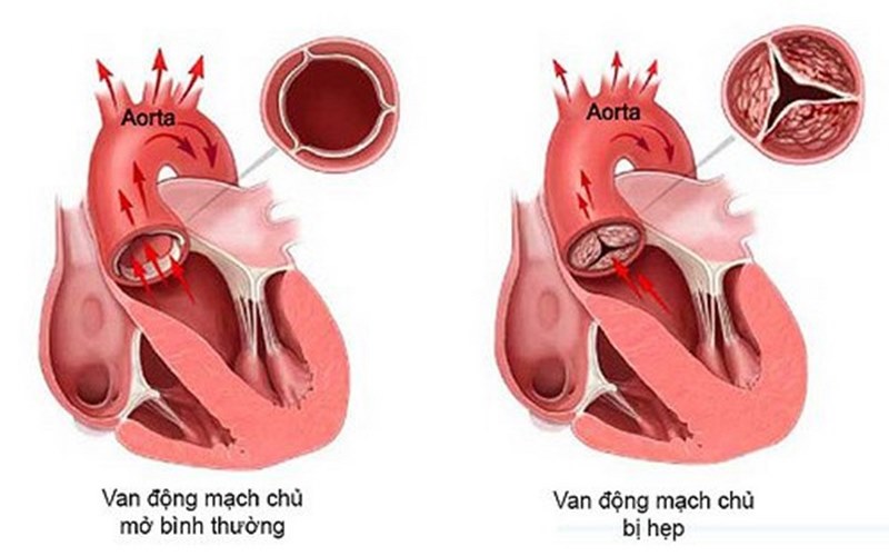 Hẹp van động mạch chủ là tình trạng nguy hiểm